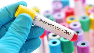 Prokalsitonin Testi