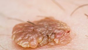 Erkeklerde HPV Belirtileri Nelerdir?