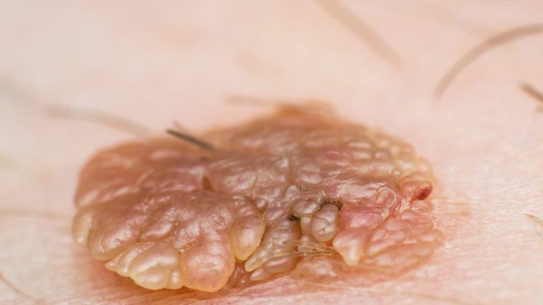 Erkeklerde HPV Belirtileri Nelerdir?