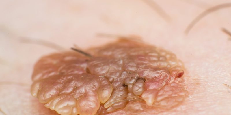 Erkeklerde HPV Belirtileri Nelerdir?
