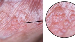 Genital Siğil Nedir?