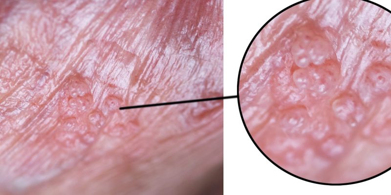 Genital Siğil Nedir?