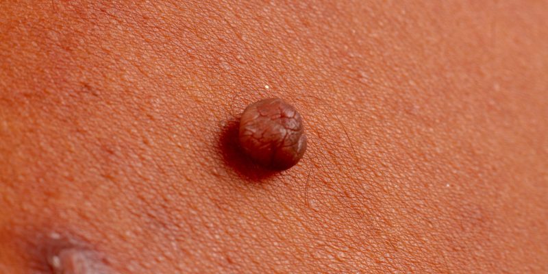 Genital Siğil Belirtileri