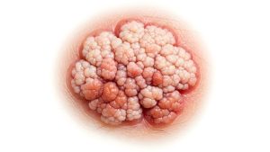 HPV Belirtileri Nelerdir?