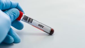 HSV Tip 2 IgG Testi