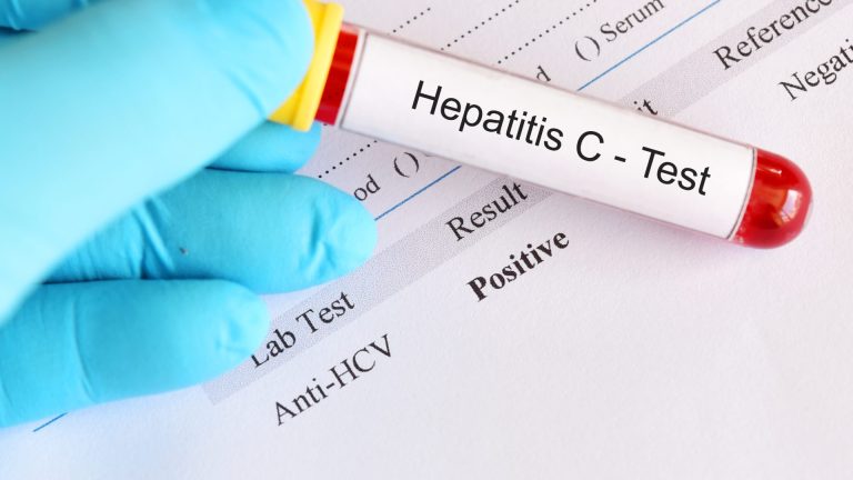 Hepatit C Testi
