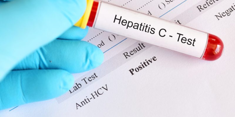 Hepatit C Testi