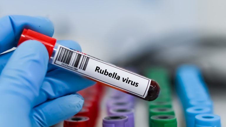 Rubella IgG Avidite Testi