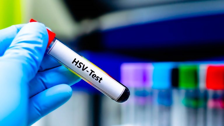 HSV DNA PCR Testi