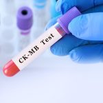 CK-MB Testi