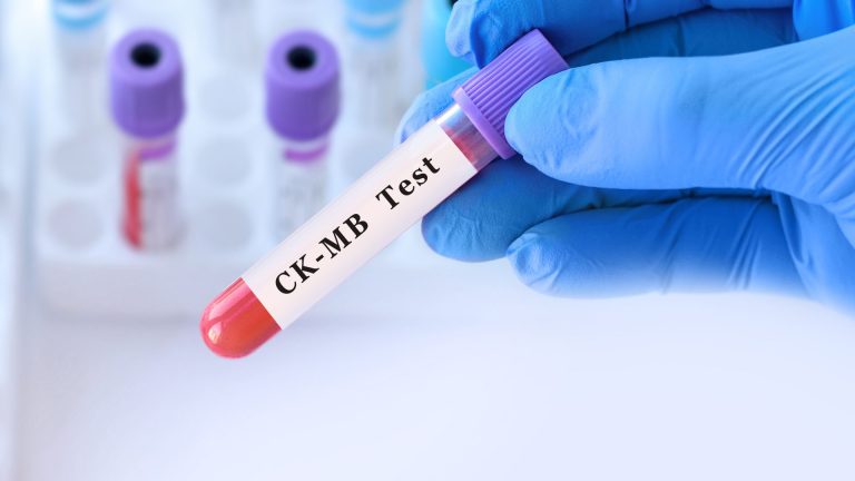 CK-MB Testi