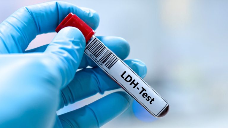 LDH Testi