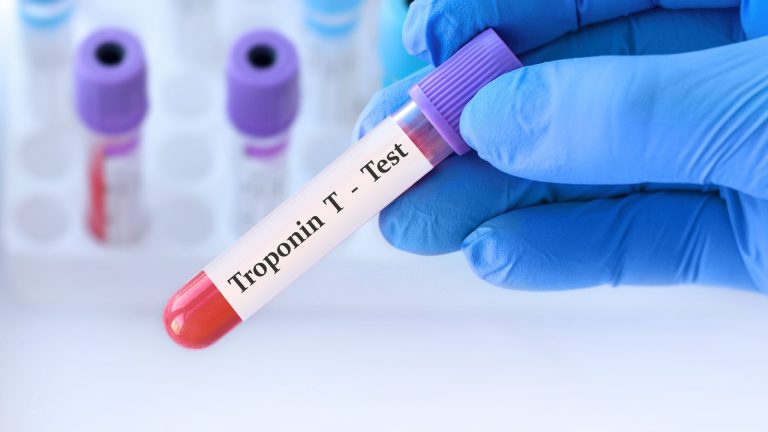 Troponin T Testi