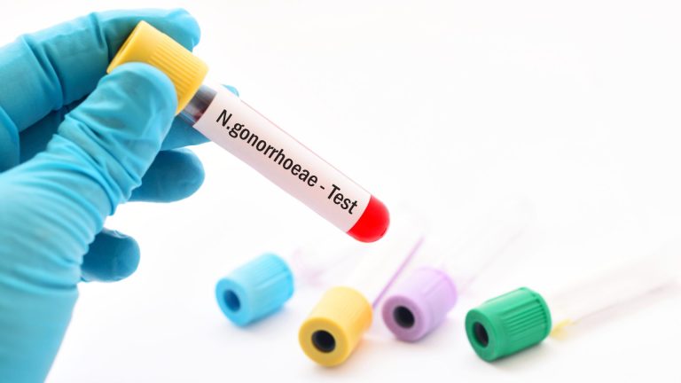Neisseria Gonorrhoeae DNA PCR Testi