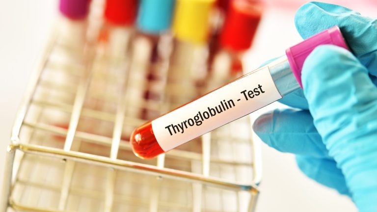 Tiroglobulin Testi