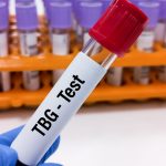 Tiroksin Bağlayıcı Globulin (TBG) Testi