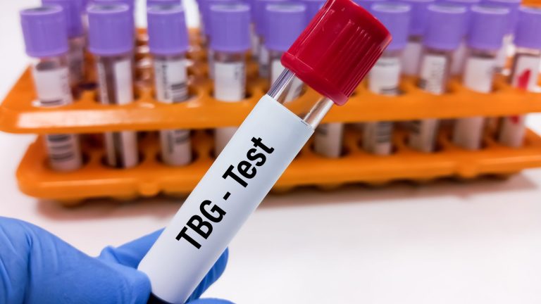 Tiroksin Bağlayıcı Globulin (TBG) Testi